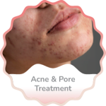 Acne and Pore Treatment
