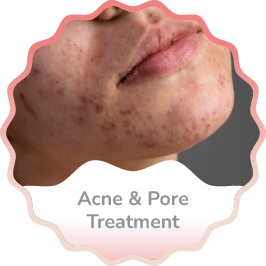 Acne and Pore Treatment