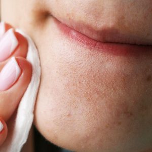 blackheads best and worst ways to get rid of this acne 1440x810 1